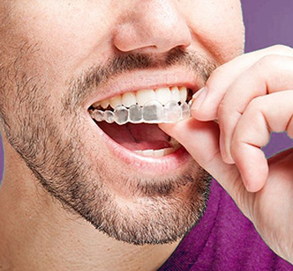 Immersion course in invisible aligners